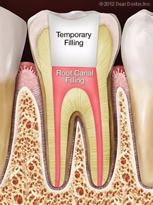 Tooth after root canal treatment.